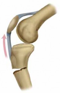 Illustration 3 for Optimal Nailing of the Tibia: Techniques for Challenging Fractures