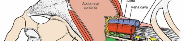 Illustration 6 for Master the Anterolateral Retroperitoneal Approach to Lumbar Spine