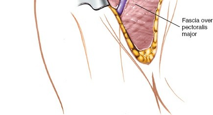 Illustration 13 for Essential Guide: Mastering Every Approach to the Shoulder