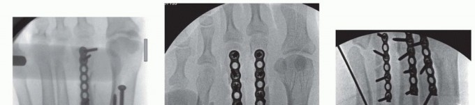 Illustration 22 for Fixation of Lisfranc Injuries: Essential Open Reduction Guide