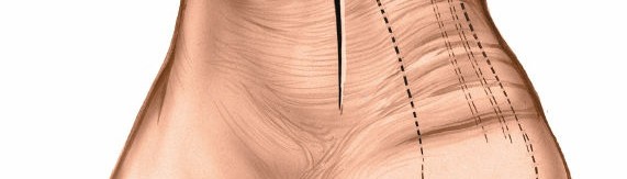 Illustration 17 for Step-by-Step Medial Side of the Ankle Approach Guide