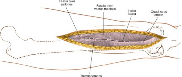 Illustration 29 for Optimal Femoral Approaches: Mastering the Lateral Intermuscular Septum