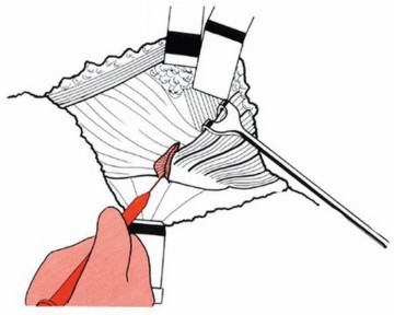 Illustration 18 for Sliding Trochanteric Osteotomy: Modern Role & Refined Techniques