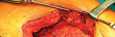 Illustration 63 for Direct Lateral Hip: Optimize Exposure with Sharp Curved Hohmann