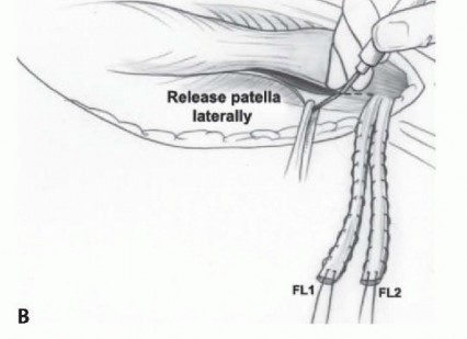 Illustration 36 for Treatment for Congenital Femoral Deficiency: What You Need to Know