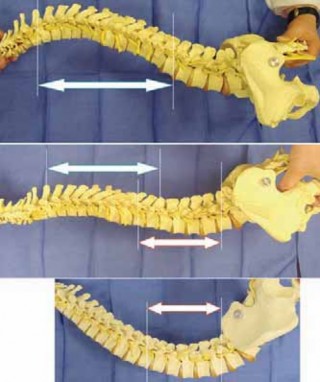 Illustration 19 for Optimizing Instrumentation for Neuromuscular Scoliosis