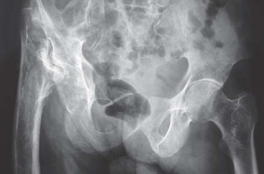 Illustration 2 for Mastering Hip Arthroplasty: Its Evolution and Design Unveiled