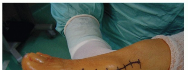 Illustration 7 for Mastering the Biplanar Distal Chevron for Effective Bunion Surgery