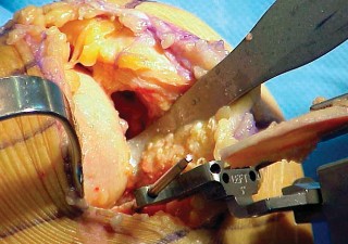 صورة توضيحية لـ تقويم مفصل الركبة أحادي الحجرة دليل شامل للمرضى في صنعاء