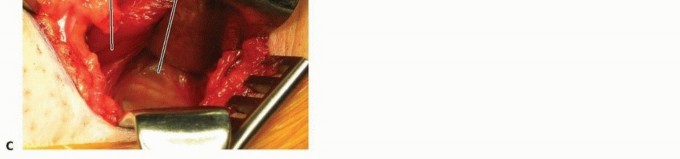 Illustration 19 for Septic Hip in Children: Mastering Anterior Drainage for Optimal Recovery