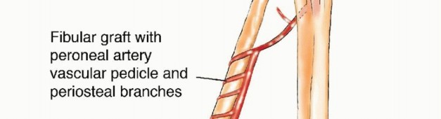 Illustration 4 for Free Vascularized Fibular Grafts: Solving Complex Bone Defects