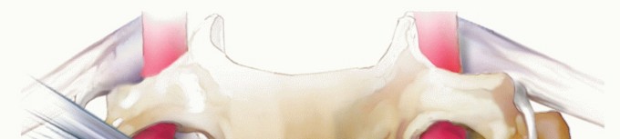 Illustration 12 for Stop Numbness & Instability: Corpectomy and Fusion Guide