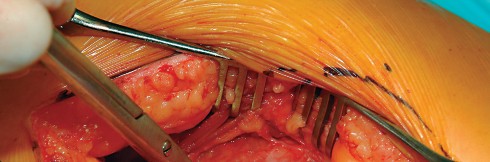 Illustration 37 for Direct Lateral Hip: Optimize Exposure with Sharp Curved Hohmann