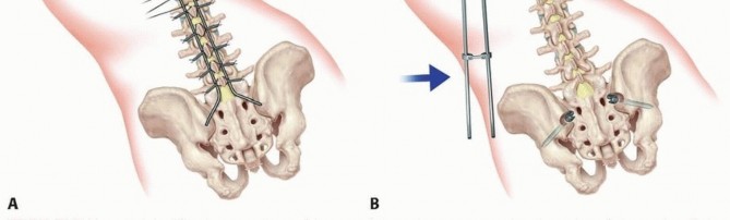Illustration 29 for Duchenne Muscular Dystrophy: Is Spinal Fusion the Answer?