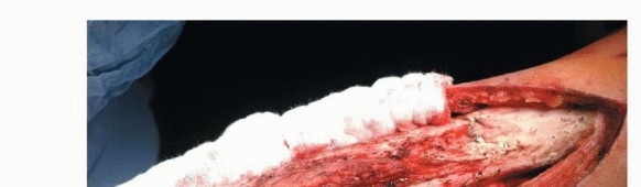 Illustration 14 for Free Vascularized Fibular Grafts: Solving Complex Bone Defects