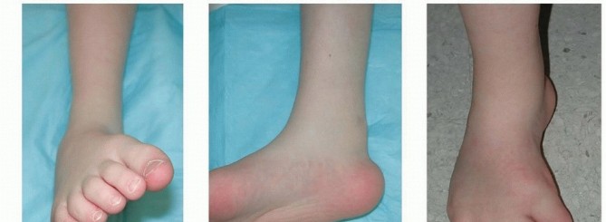 Illustration 7 for Why Anterior Tibialis Muscle Transfer Fixes Clubfoot