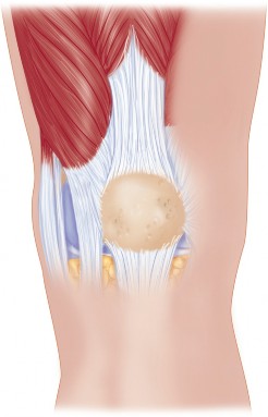 Minimal Incision Total Knee: Experience Faster Healing
