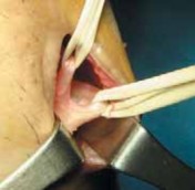 Illustration 11 for Optimizing Single-Bundle Anterior Cruciate Ligament Repair