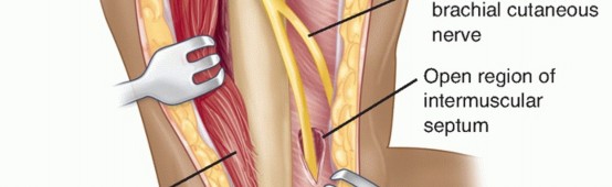 Illustration 25 for Surgical Approaches to Shoulder & Elbow: Pearls and Pitfalls