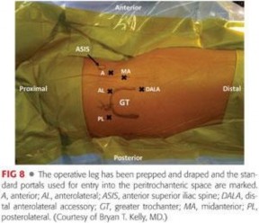 Illustration 94 for Periarticular Arthroscopy: Addressing Medius & Minimus Tears