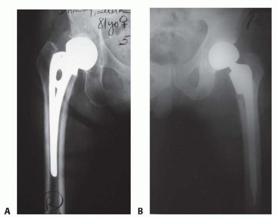 Hemiarthroplasty of the Hip: Indications & Types Explained