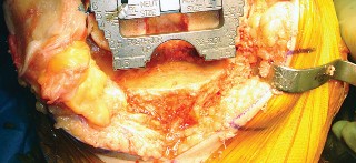 Illustration 35 for Mastering TKA: Essential Methods of Rotational Alignment