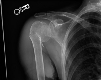 Proximal Humerus Fractures: Epidemiology, Advanced Anatomy & Biomechanics