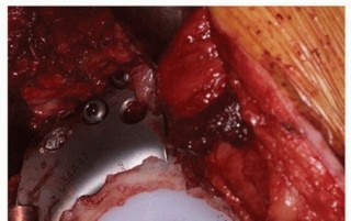 Illustration 16 for Uncemented Acetabular Component: Augments & Cup-Cages for Bone Loss