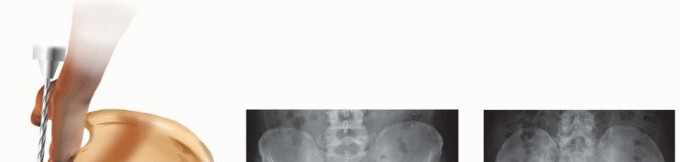 Illustration 21 for Achieve Stable Fixation of the Symphysis: Open Reduction