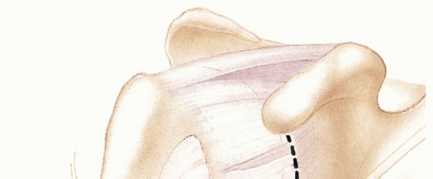 Illustration 20 for Bankart Repair & Inferior Capsular Shift: Solving Shoulder Instability