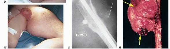 Illustration 7 for Posterior Flap Hemipelvectomy: Mastering Techniques for Optimal Outcomes