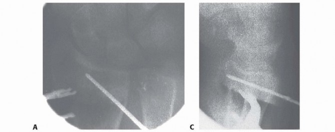 Illustration 14 for Precision Correction for Distal Radius Malunion