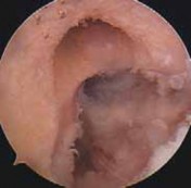 Illustration 69 for Optimizing Single-Bundle Anterior Cruciate Ligament Repair