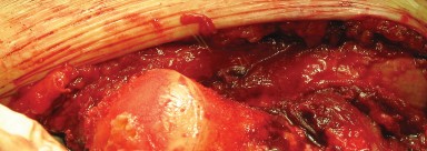 Illustration 43 for Figure Hip Resurfacing: Who Benefits and Who Should Avoid It?