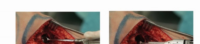 Illustration 4 for Avoid Major Surgery: Bone Tumor Treatment with Liquid Nitrogen Pour