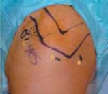 Illustration 12 for Capsular Releases for Loss of Motion: Restore Your Shoulder