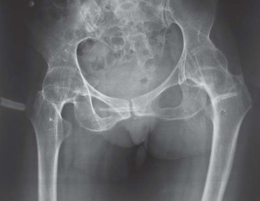 Illustration 9 for Total Hip Arthroplasty: Restoring Mobility in Juvenile Idiopathic Arthritis