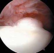 Illustration 13 for Resolving Femoral Head Neck Impingement: Arthroscopic FAI Solutions