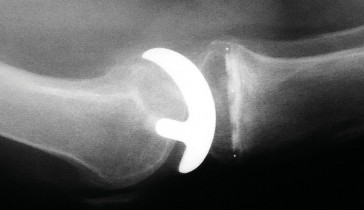 صورة توضيحية لـ تقويم مفصل الركبة أحادي الحجرة دليل شامل للمرضى في صنعاء