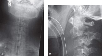 Adjacent Segment Degeneration: Your Next Spine Case Solved