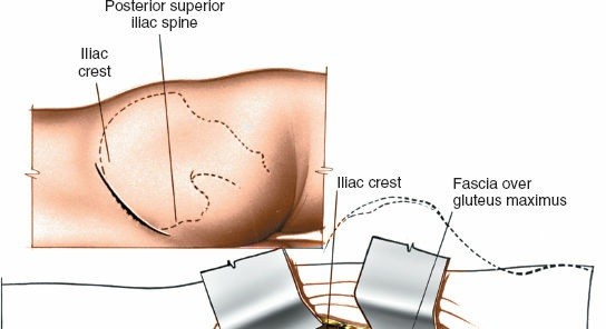 Illustration 10 for Pelvis & Acetabulum Approaches: Unlocking the Posterior Superior Iliac