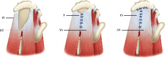 Illustration 3 for Irreparable Rotator Cuff Tears: What Are Your Treatment Options?