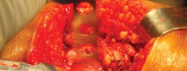 Illustration 17 for The Silent Hip: Achieving a Truly Silent, Pain-Free Joint