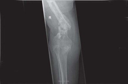 Illustration 72 for Optimizing Infected THA: The One Staged Approach Explained