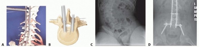 Illustration 27 for Duchenne Muscular Dystrophy: Is Spinal Fusion the Answer?