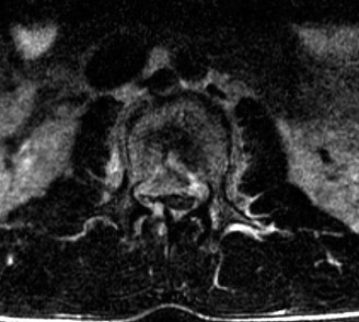 Illustration 12 for Spine Cases: Consider the Patient for Accurate Diagnosis