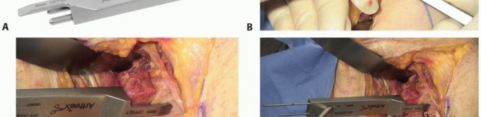 Illustration 23 for Latarjet for Instability: Bone Loss Solutions, Per Burkhart SS, Lo