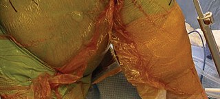 Illustration 21 for Optimize Tibial Component Alignment: Techniques for TKA Success