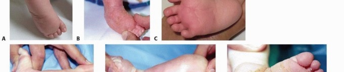 Illustration 2 for Resistant Clubfoot Solved: Posteromedial and Posterolateral Release