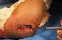 Lateral Condyle Fractures: Optimize ORIF to Prevent Tardy Ulnar Nerve